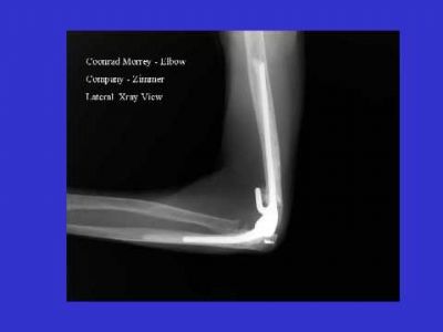 Coonrad-Morey Total Elbow Prosthesis (Implant 149)